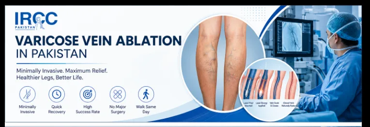 ircc varicose vein treatment pakistan